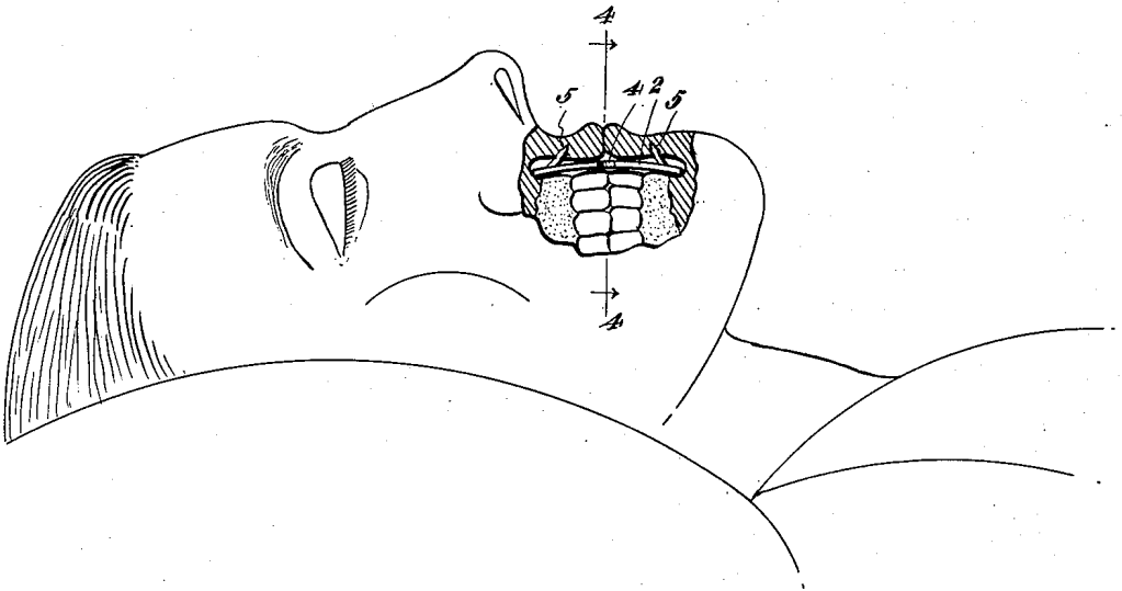 Side view of a corpse in repose. A cut-away view of the mouth shows a plate between the lips and teeth, with prongs that penetrate the inner surface of the lips.